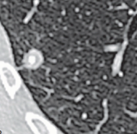 Central Calcification