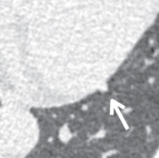 Perimediastinal