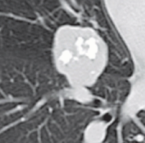 Popcorn Calcification
