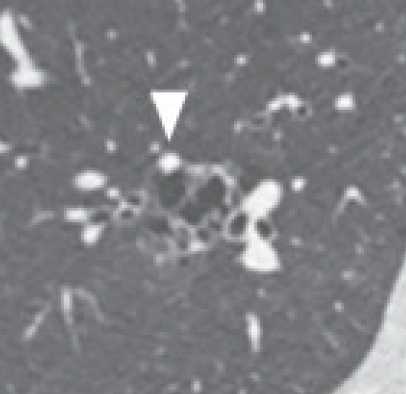 Nodules Exophytic
